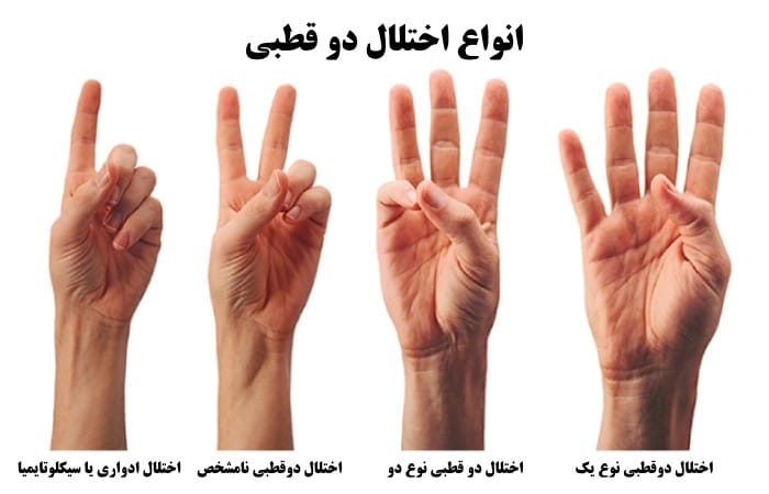 انواع اختلال دو قطبی
